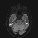 File:Bilateral and symmetric thalamic glioma (Radiopaedia 66119-75289 Axial DWI 7).jpg
