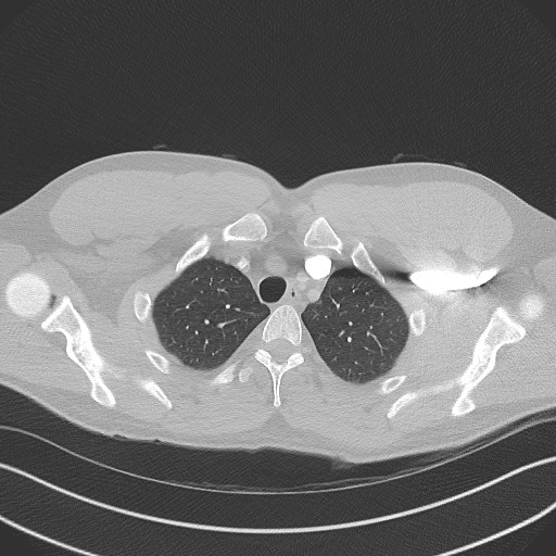 Bilateral atelectasis (Radiopaedia 48666-53675 Axial lung window 15).jpg