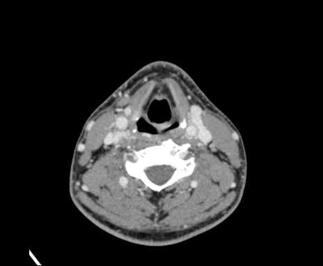 File:Bilateral carotid body tumors (Radiopaedia 61841-69870 Axial Post contrast 65).jpg