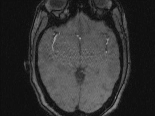 Bilateral carotid body tumors and right glomus jugulare tumor (Radiopaedia 20024-20060 Axial MRA 343).jpg
