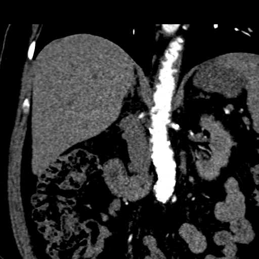 File:Bilateral delayed nephrogram from renal artery stenosis (Radiopaedia 47681-52362 C 5).png