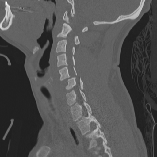 Bilateral locked facets (Radiopaedia 33850-35016 Sagittal bone window 16).png