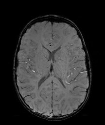 Bilateral mesial temporal polymicrogyria (Radiopaedia 76456-88181 Axial SWI 39).jpg