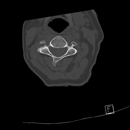 Bilateral occipital condyle fractures (type 3) (Radiopaedia 87672-104086 Axial bone window 34).jpg