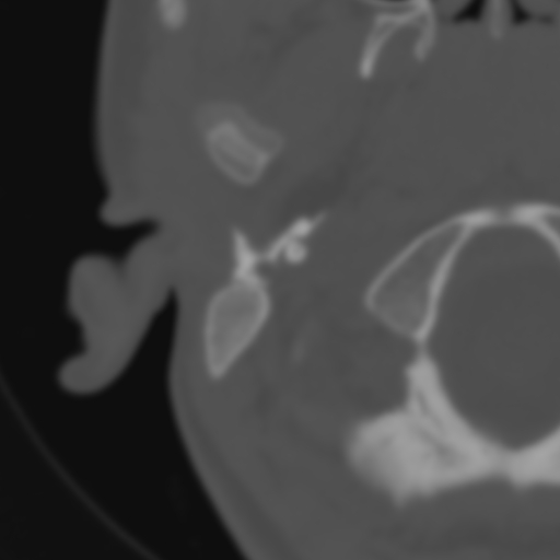 Bilateral otosclerosis (Radiopaedia 57237-64157 B 10).jpg