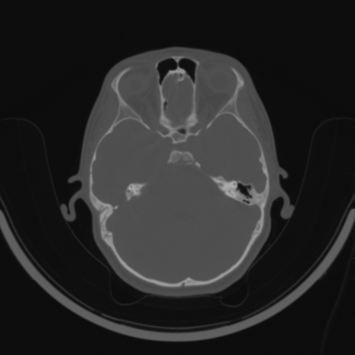 Bilateral otosclerosis (Radiopaedia 57237-64157 C 60).jpg