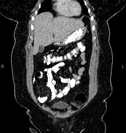 Bilateral ovarian dermoid cysts (Radiopaedia 85785-101603 C 7).jpg