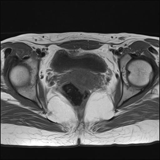 File:Bilateral ovarian endometriomas (Radiopaedia 87085-103347 Axial T1 15).jpg