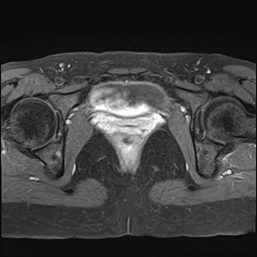 File:Bilateral ovarian endometriomas (Radiopaedia 87085-103347 Axial T1 C+ fat sat 18).jpg