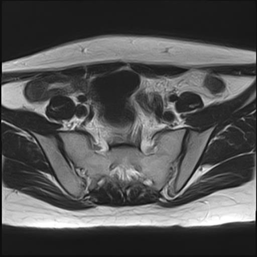 File:Bilateral ovarian endometriomas (Radiopaedia 87085-103347 Axial T2 4).jpg