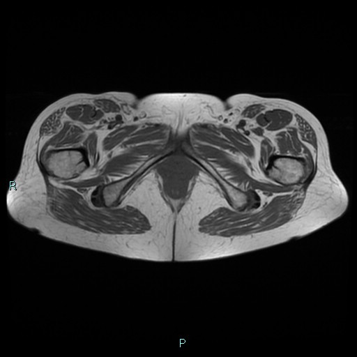 File:Bilateral ovarian fibroma (Radiopaedia 44568-48293 Axial T1 29).jpg