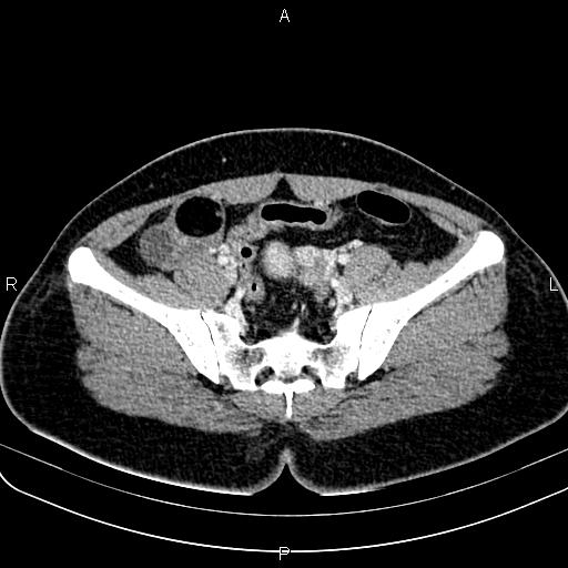 File:Bilateral ovarian teratoma (Radiopaedia 83131-97503 Axial With contrast 29).jpg