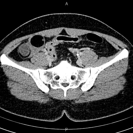 Bilateral ovarian teratoma (Radiopaedia 83131-97503 B 24).jpg