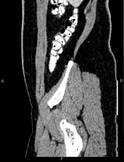 Bilateral ovarian teratoma (Radiopaedia 83131-97503 D 29).jpg