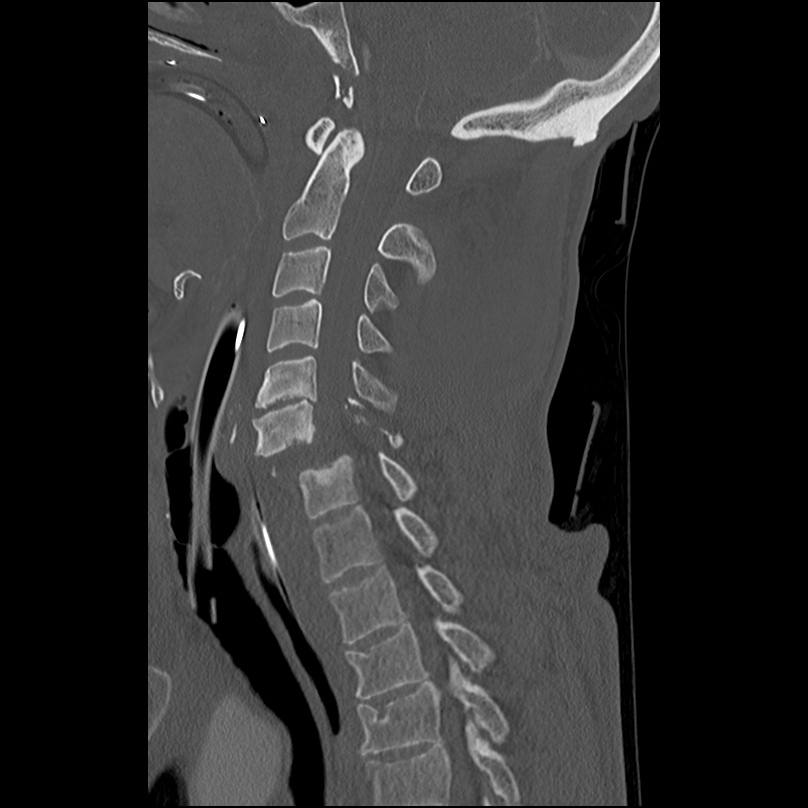 Bilateral perched facets with cord injury (Radiopaedia 45587-49713 Sagittal bone window 25).jpg