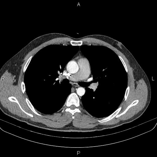 File:Bilateral pulmonary AVM (Radiopaedia 83134-97505 A 32).jpg