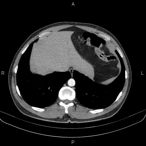 Bilateral pulmonary AVM (Radiopaedia 83134-97505 A 61).jpg