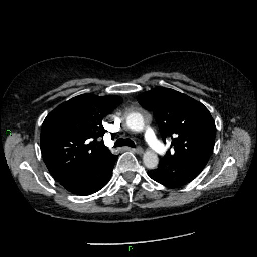 Bilateral pulmonary emboli (Radiopaedia 32700-33669 Axial C+ CTPA 39).jpg