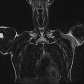 Bilateral spinoglenoid notch ganglion cysts (Radiopaedia 29577-30082 Coronal T2 23).jpg