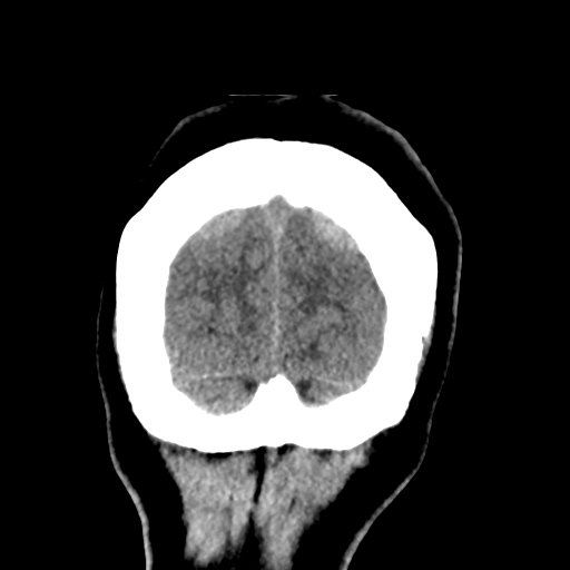 Bilateral subacute subdural hematoma (Radiopaedia 69240-79018 Coronal non-contrast 53).jpg