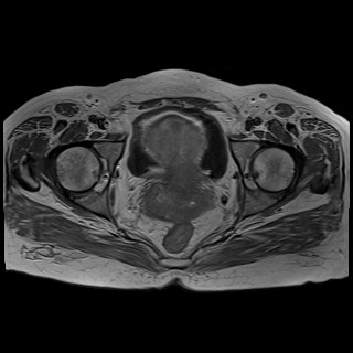 Bilateral tubo-ovarian abscesses (Radiopaedia 58635-65829 Axial T1 C+ 36).jpg