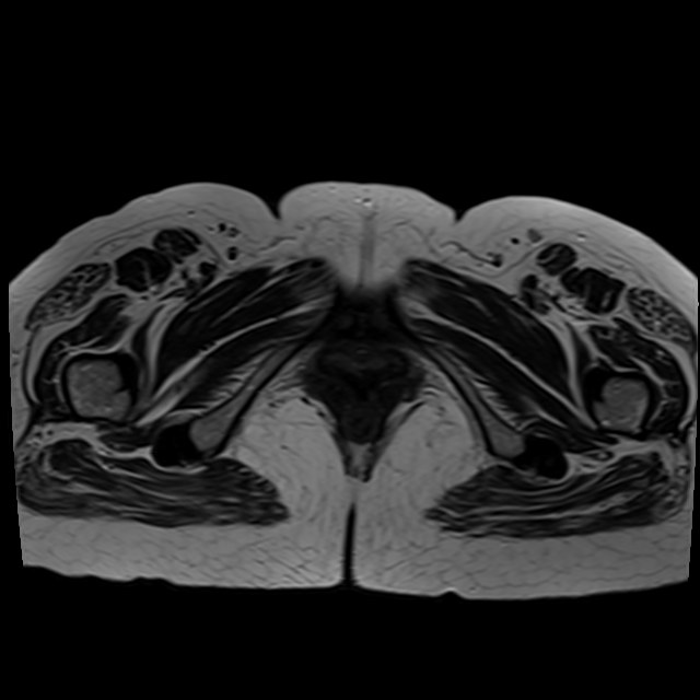 Bilateral tubo-ovarian abscesses (Radiopaedia 58635-65829 Axial T2 47).jpg