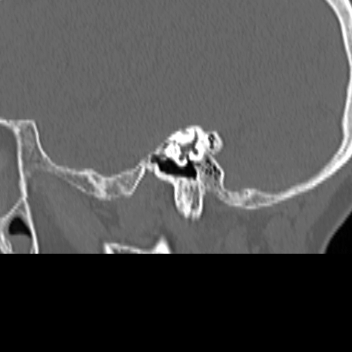 Bilateral tympanoplasty (Radiopaedia 16947-16664 Sagittal bone window 33).jpg
