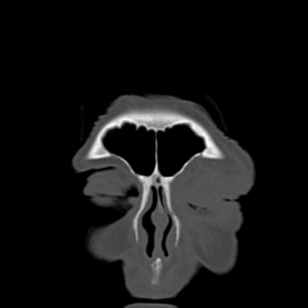 Biparietal osteodystrophy (Radiopaedia 46109-50463 Coronal bone window 15).jpg