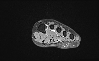 File:Bipartite hallux sesamoid diastasis (Radiopaedia 77133-89109 Coronal T2 fat sat 14).jpg