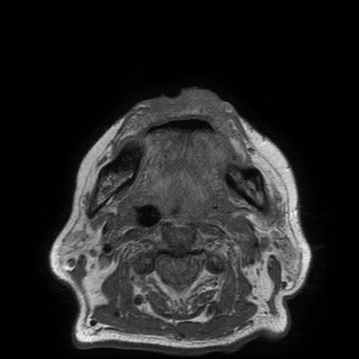 Bisphosphonate-related osteonecrosis of the maxilla (Radiopaedia 51367-57101 Axial T1 10).jpg