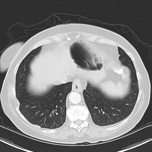 Bladder and bowel cancers (Radiopaedia 37688-39592 Axial lung window 42).png