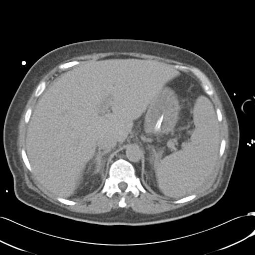 Bladder rupture post renal biopsy (Radiopaedia 30863-31572 Axial non-contrast 22).jpg