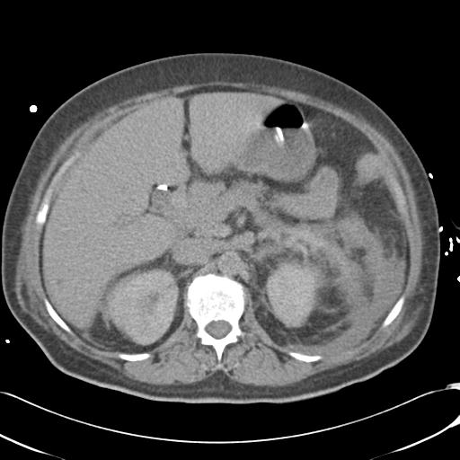 File:Bladder rupture post renal biopsy (Radiopaedia 30863-31572 Axial non-contrast 30).jpg