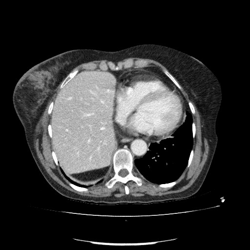 File:Bladder tumor detected on trauma CT (Radiopaedia 51809-57609 B 15).jpg