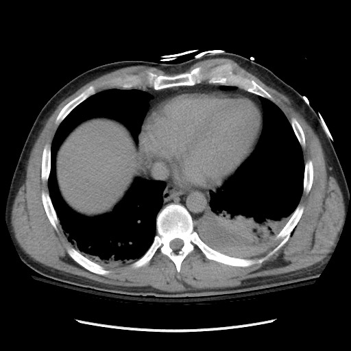 Blunt abdominal trauma with solid organ and musculoskelatal injury with active extravasation (Radiopaedia 68364-77895 Axial C+ delayed 12).jpg