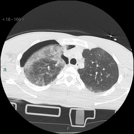 Blunt chest trauma (Swiss cheese sign) (Radiopaedia 38519-40618 Axial lung window 16).jpg