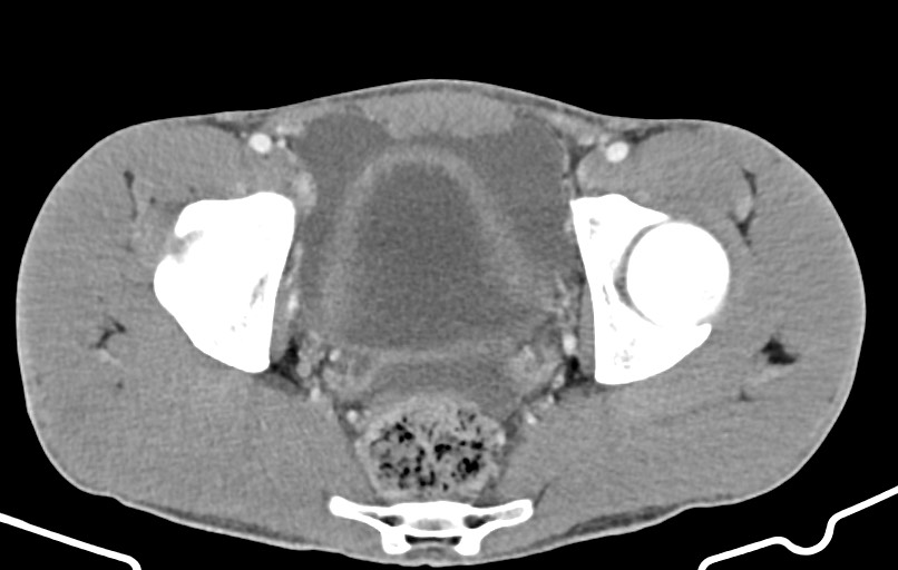 Blunt injury to the small bowel (Radiopaedia 74953-85987 A 175).jpg