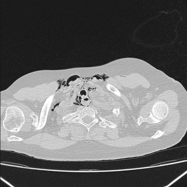 Boerhaave syndrome (Radiopaedia 45644-49799 Axial lung window 27).jpg