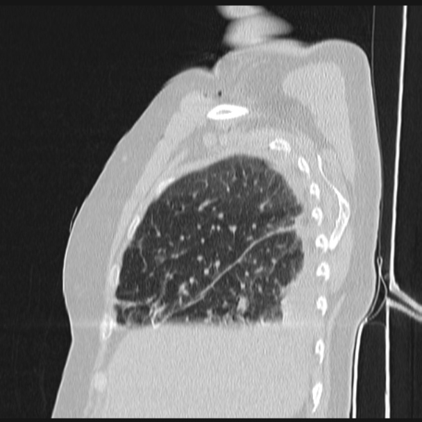 Boerhaave syndrome (Radiopaedia 45644-49799 Sagittal lung window 17).jpg