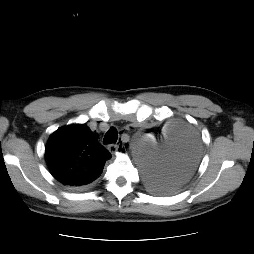 Boerhaave syndrome (Radiopaedia 59796-67310 Axial liver window 17).jpg