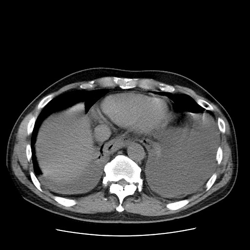 Boerhaave syndrome (Radiopaedia 59796-67310 Axial liver window 49).jpg