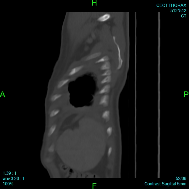 Bone metastases from lung carcinoma (Radiopaedia 54703-60937 Sagittal bone window 52).jpg