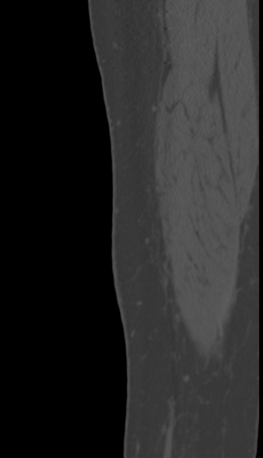Bone metastasis - tibia (Radiopaedia 57665-64609 Sagittal bone window 1).jpg