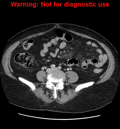 File:Bosniak renal cyst - type II (Radiopaedia 23404-23468 F 39).jpg