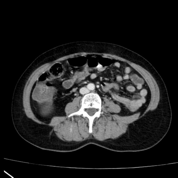 Bosniak renal cyst - type I (Radiopaedia 27479-27675 C 53).jpg