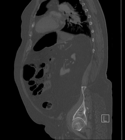 File:Bowel ischemia secondary to SMA occlusion with extensive portomesenteric venous gas (Radiopaedia 54656-60871 Sagittal bone window 32).jpg