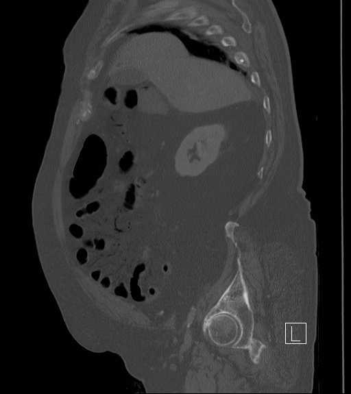 Bowel ischemia secondary to SMA occlusion with extensive portomesenteric venous gas (Radiopaedia 54656-60871 Sagittal bone window 84).jpg