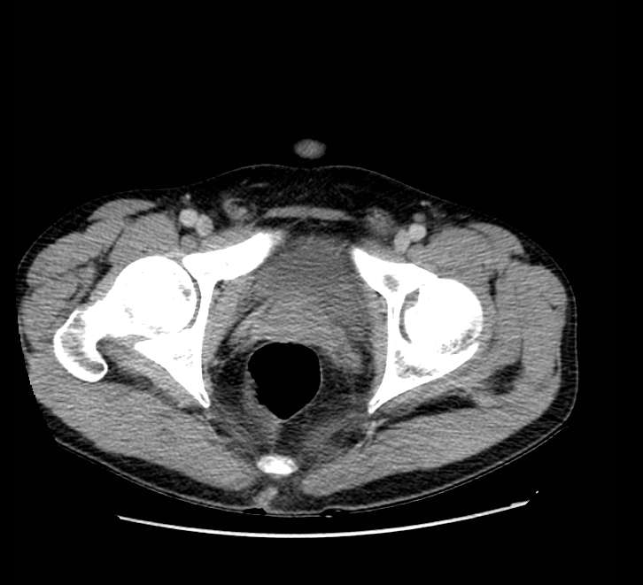 Bowel obstruction from colon carcinoma (Radiopaedia 22995-23028 A 83).jpg