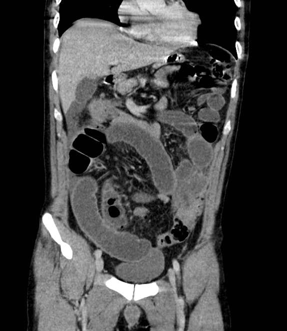 Bowel obstruction from colon carcinoma (Radiopaedia 22995-23028 C 25).jpg