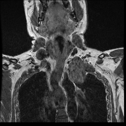 File:Brachial plexus neurofibroma (Radiopaedia 28030-28291 Coronal T1 9).png